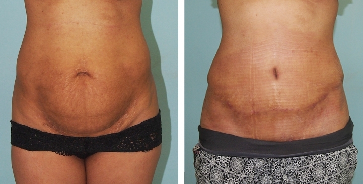 Contouring Corporeo / Lipectomia 43 lg 6494959b06ea0 image