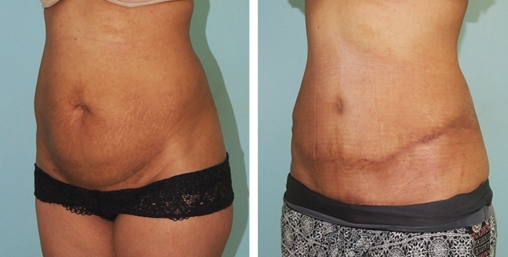 Contouring Corporeo / Lipectomia 44 lg 6494959b08f6c image