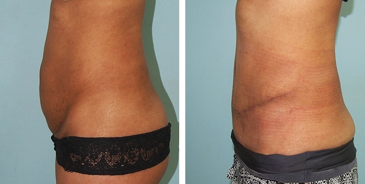 Contouring Corporeo / Lipectomia 47 lg 6494959b0b008 image