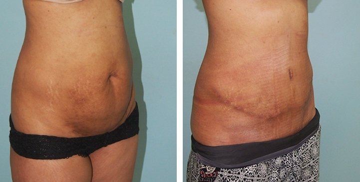 Contouring Corporeo / Lipectomia 46 lg 6494959b0cf6f image