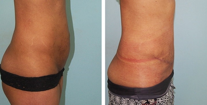 Contouring Corporeo / Lipectomia 45 lg 6494959b0efdb image