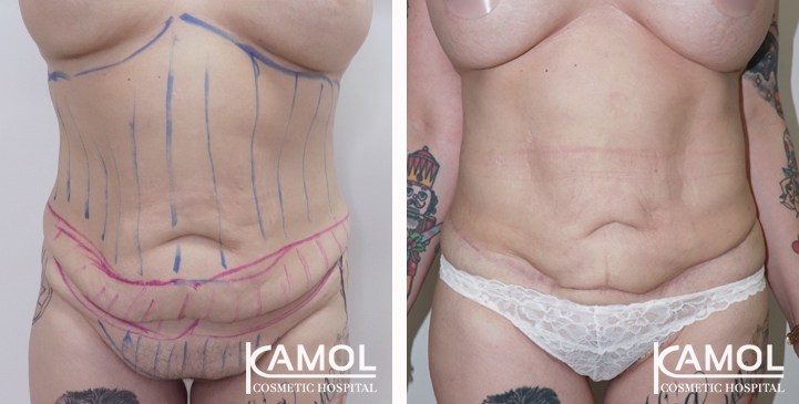 Contouring Corporeo / Lipectomia 49 lg 6494959b11c14 image