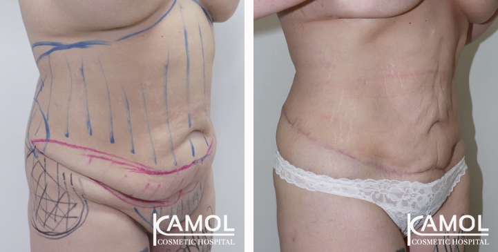 Contouring Corporeo / Lipectomia 51 lg 6494959b13d68 image