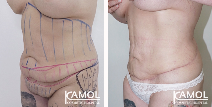 Contouring Corporeo / Lipectomia 50 lg 6494959b15d7a image