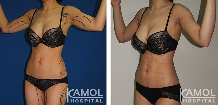 Lipoaspiração nos braços 5 lg 6494959c0c90f image