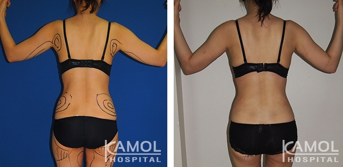 Lipoaspiração nos braços 4 lg 6494959c0e2cd image