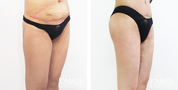 Thighs Lift 3 lg 6494959c2e774 image