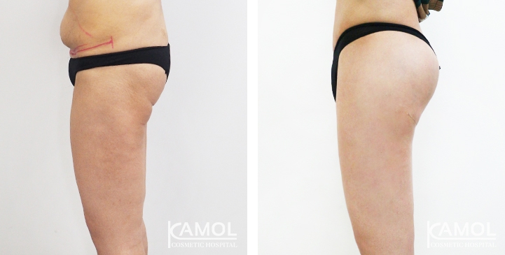 Thighs Lift 6 lg 6494959c347cd image