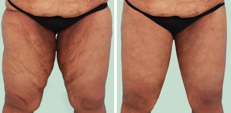 Thighs Lift 10 lg 6494959c3c0bb image