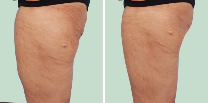 Thighs Lift 11 lg 6494959c3e3c1 image