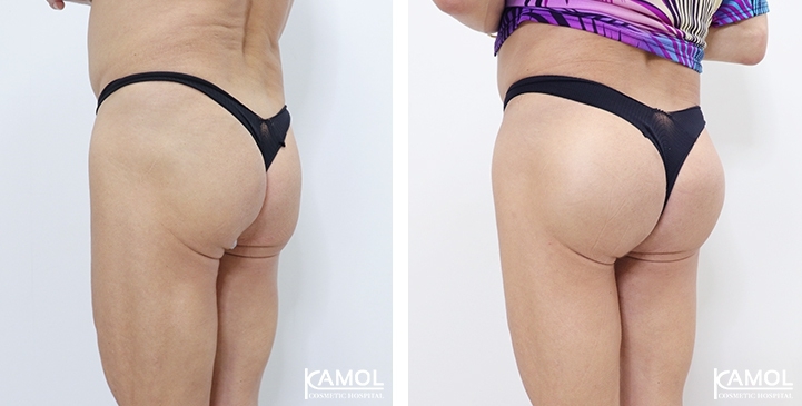 Aumento dei Glutei 3 lg 6494959c9182a image