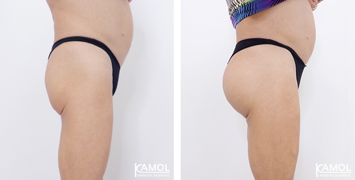 Aumento dei Glutei 5 lg 6494959c9875a image