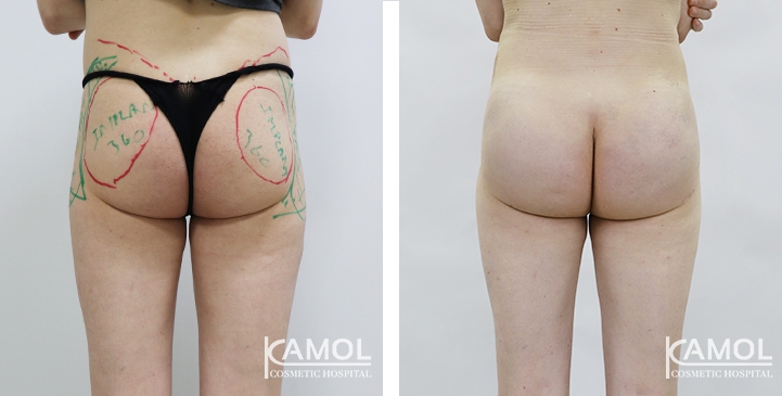 Aumento dei Glutei 8 lg 6494959c9b38c image