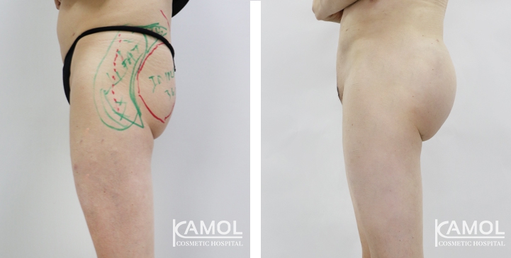Aumento dei Glutei 10 lg 6494959c9f615 image