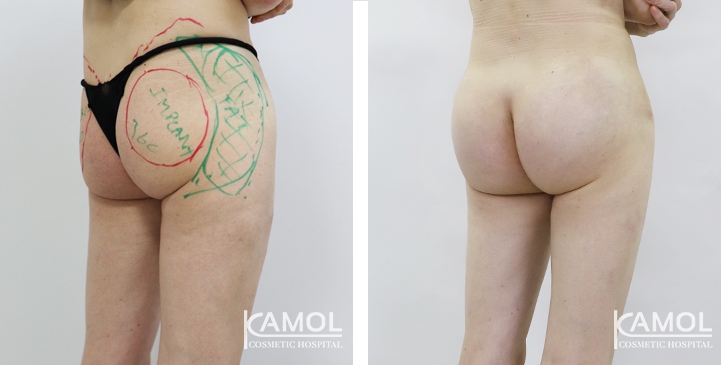 Aumento dei Glutei 11 lg 6494959ca1671 image