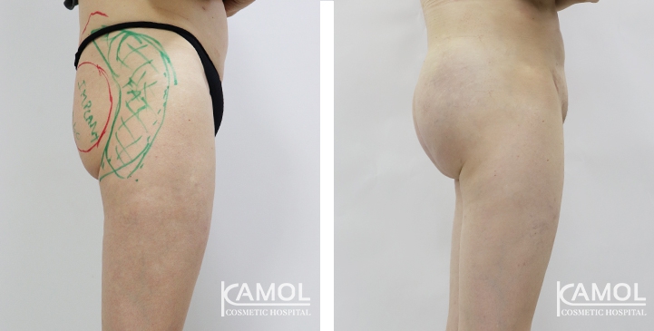 Aumento dei Glutei 12 lg 6494959ca3589 image