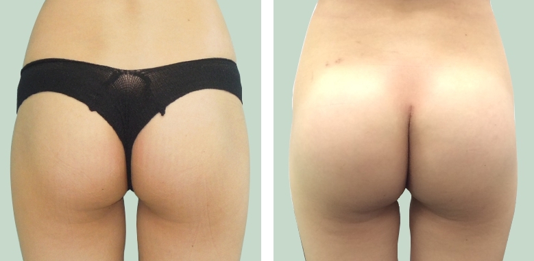 Aumento dei Glutei 14 lg 6494959ca6154 image