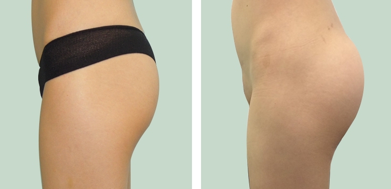 Aumento dei Glutei 15 lg 6494959ca7f0d image