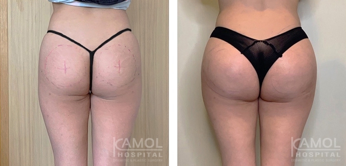 Aumento dei Glutei 17 lg 6494959caa7b0 image