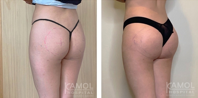 Aumento dei Glutei 19 lg 6494959cac5d4 image