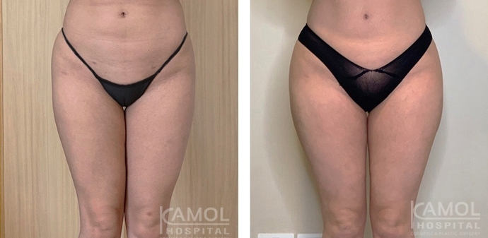 Aumento dei Glutei 18 lg 6494959cae574 image