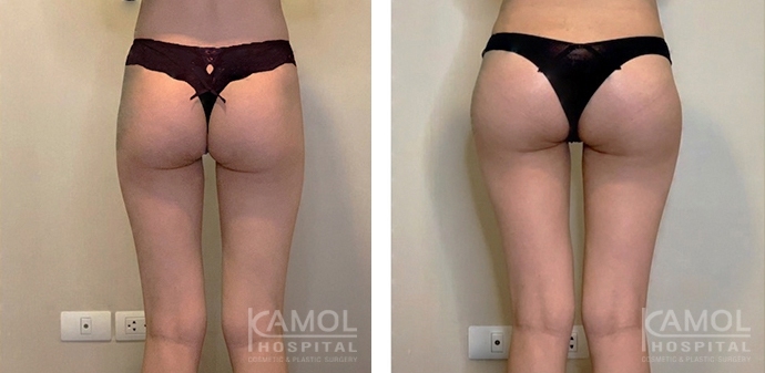 Aumento dei Glutei 21 lg 6494959cb1184 image