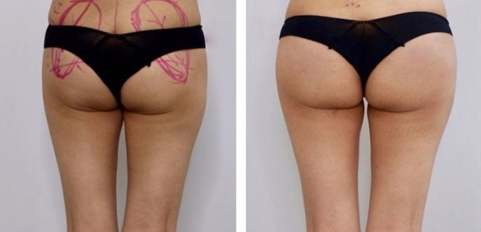 Aumento dei Glutei 25 lg 6494959cb7705 image