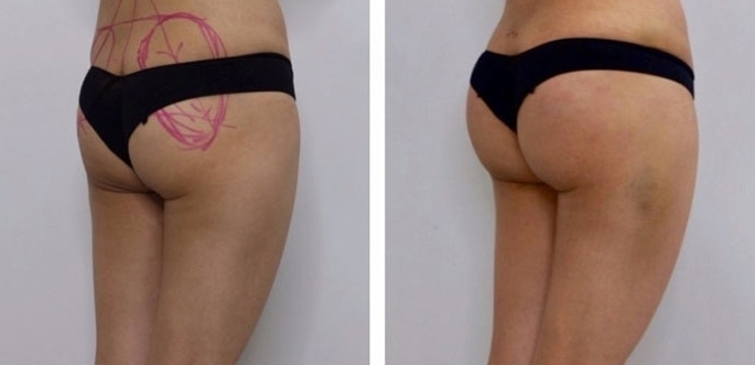 Aumento dei Glutei 27 lg 6494959cb93ae image