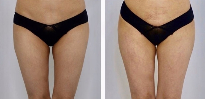 Aumento dei Glutei 26 lg 6494959cbb2dd image
