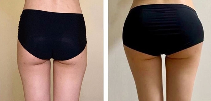 Aumento dei Glutei 29 lg 6494959cbe1a8 image