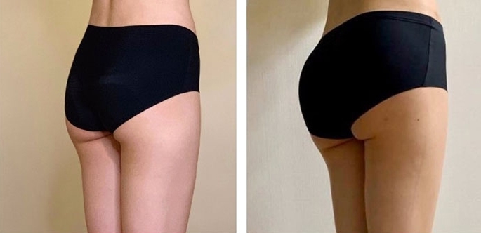 Aumento dei Glutei 31 lg 6494959cbffb3 image