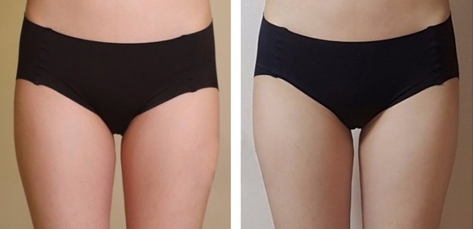 Aumento dei Glutei 30 lg 6494959cc1f00 image
