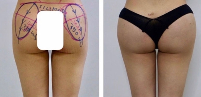 Aumento dei Glutei 33 lg 6494959cc49c6 image