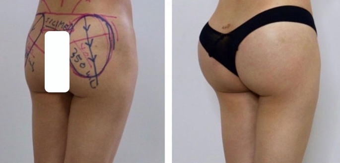 Aumento dei Glutei 35 lg 6494959cc674b image