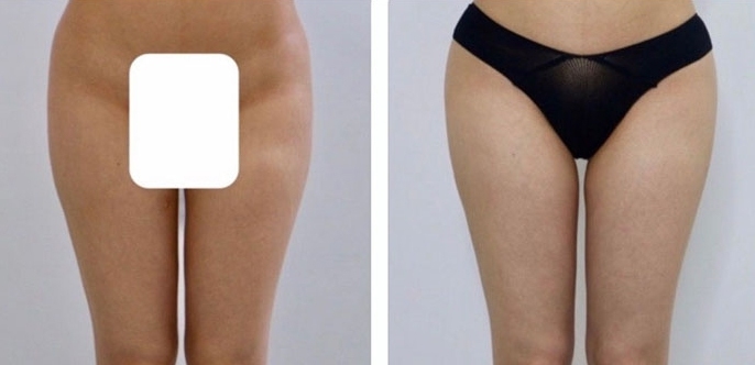 Aumento dei Glutei 34 lg 6494959cc855a image