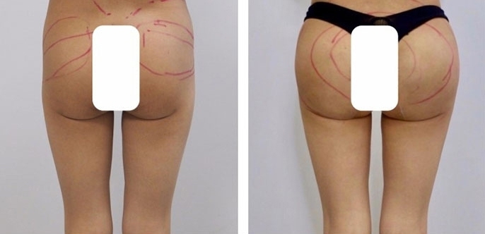 Aumento dei Glutei 37 lg 6494959ccb021 image
