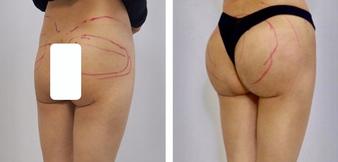 Aumento dei Glutei 39 lg 6494959cccead image