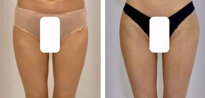 Aumento dei Glutei 38 lg 6494959cceea1 image