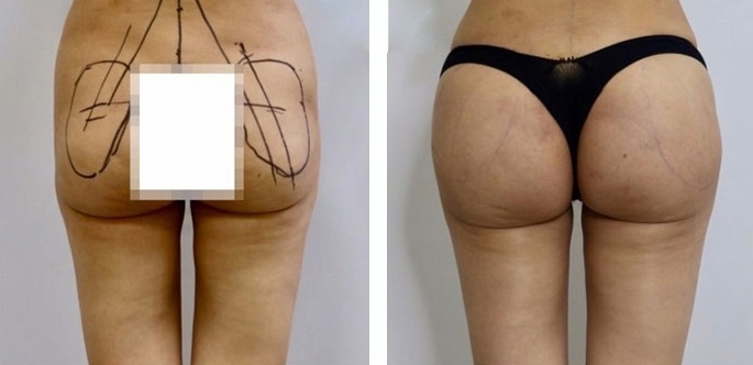Aumento dei Glutei 41 lg 6494959cd40a3 image