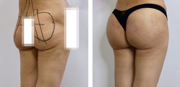 Aumento dei Glutei 42 lg 6494959cd630b image