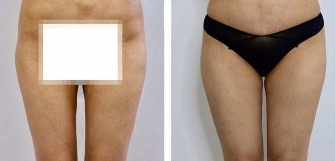 Aumento dei Glutei 43 lg 6494959cd8b3e image