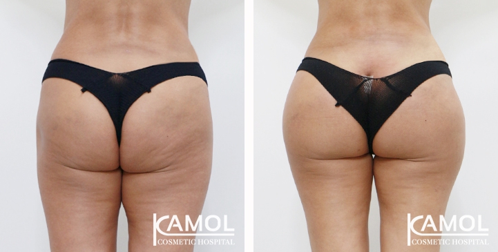 Aumento dei Glutei 45 lg 6494959cdb7e6 image