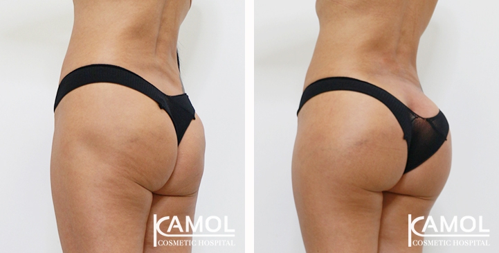 Aumento dei Glutei 49 lg 6494959cdd7c1 image