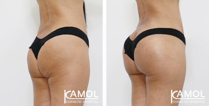 Aumento dei Glutei 48 lg 6494959cdf723 image