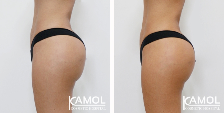 Aumento dei Glutei 46 lg 6494959ce359b image