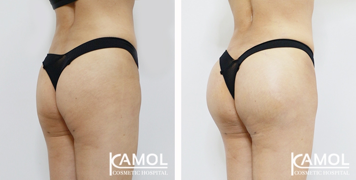 Aumento dei Glutei 55 lg 6494959ce5f76 image