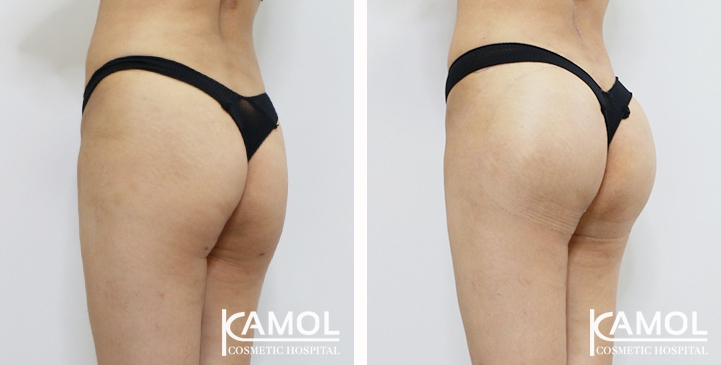 Aumento dei Glutei 53 lg 6494959ce800f image