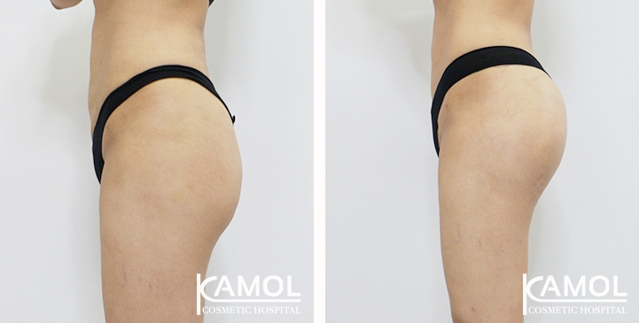 Aumento dei Glutei 54 lg 6494959ce9e79 image