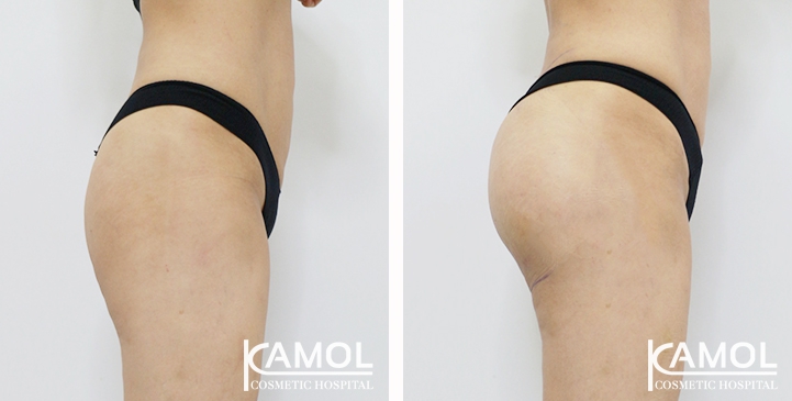 Aumento dei Glutei 52 lg 6494959cebd75 image