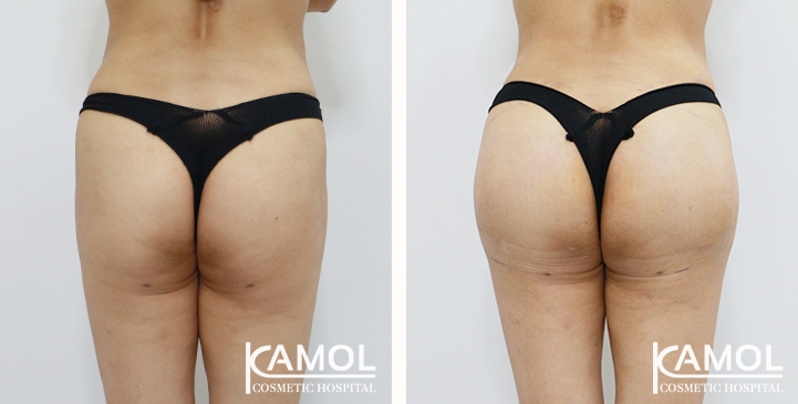 Aumento dei Glutei 51 lg 6494959cedbdf image